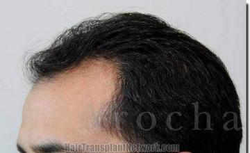 Hair restoration procedure results