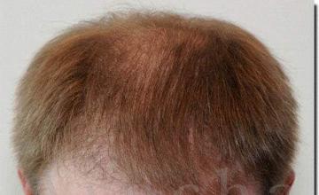 Hair restoration procedure results