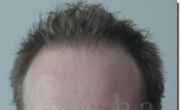 Hair restoration procedure results