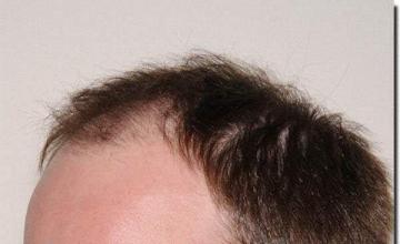 Hair restoration procedure results