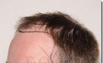 Hair restoration procedure results