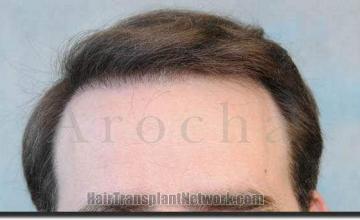 Hair restoration procedure results