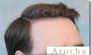 Hair restoration procedure results