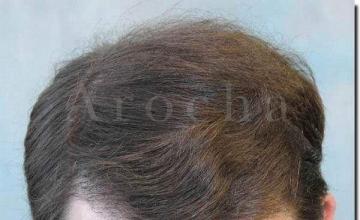 Hair restoration procedure results