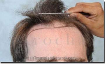 Hair restoration procedure results