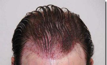 Hair restoration procedure results