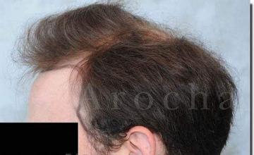 Hair restoration procedure results