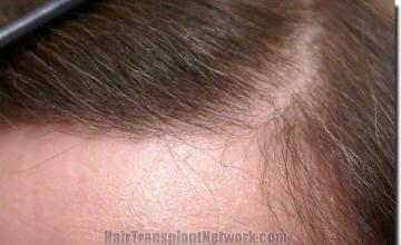 Hair restoration procedure results