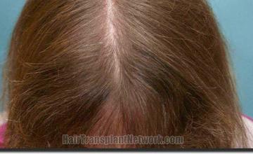 Hair restoration procedure results