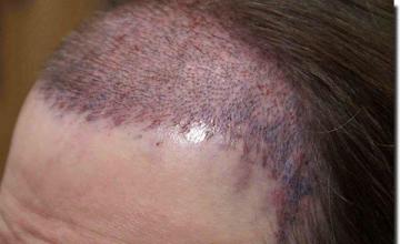 Hair restoration procedure results