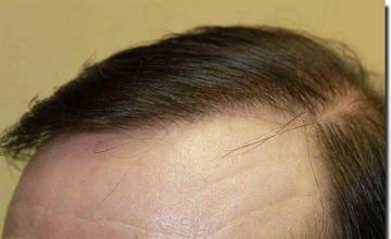 Hair restoration procedure results