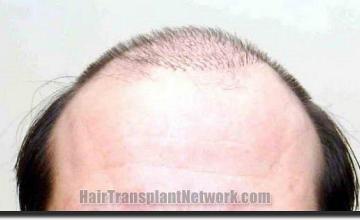 Hair restoration procedure results