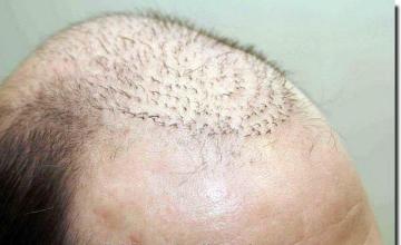 Hair restoration procedure results