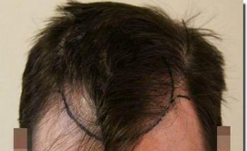 Hair restoration procedure results