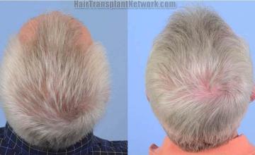 Hair replacement surgery before and after images