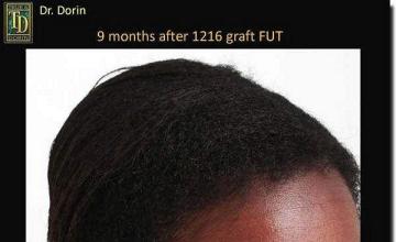 Hair restoration procedure results