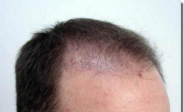 Hair restoration procedure results