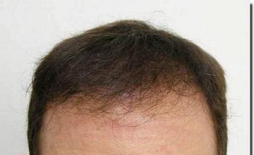 Hair restoration procedure results