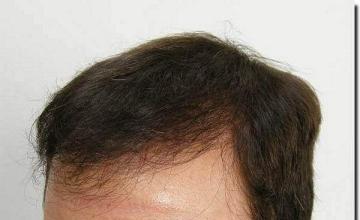 Hair restoration procedure results