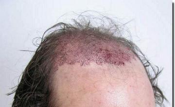 Hair restoration procedure results