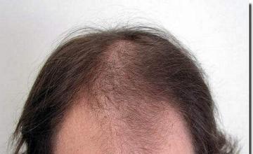 Hair restoration procedure results