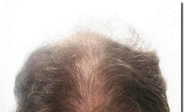 Hair restoration procedure results