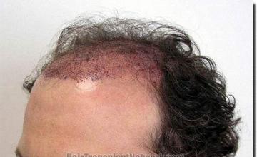 Hair restoration procedure results