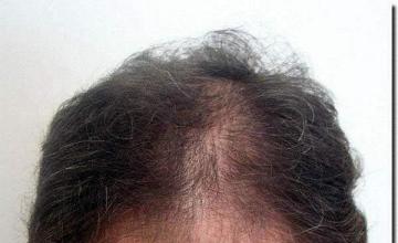 Hair restoration procedure results