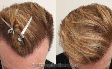 Before and after hair restoration procedure images