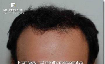 Hair restoration procedure results