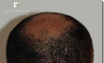 Hair restoration procedure results