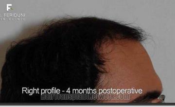 Hair restoration procedure results