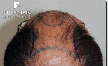 Hair restoration procedure results