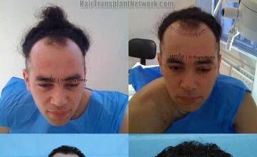 Hair transplantation surgery before and after pictures