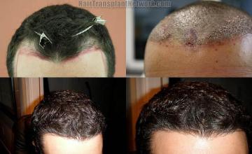 Hair restoration procedure before and after results