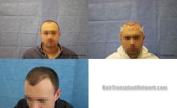 Hair restoration procedure before and after results