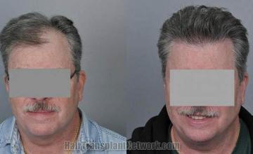 Hair restoration procedure before and after results