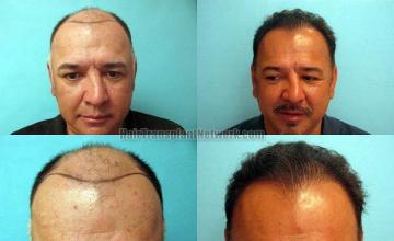 Hair restoration procedure before and after results