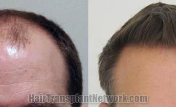 Hair transplantation surgery before and after photos