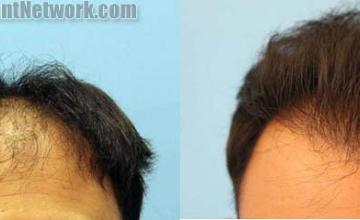 Before and after hair transplantation result photographs