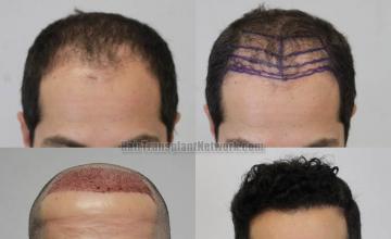 Front view - Before and after eyebrow transplant surgery