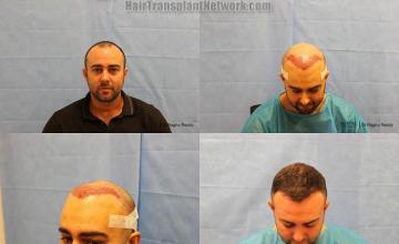 Hair transplantation surgery before and after pictures