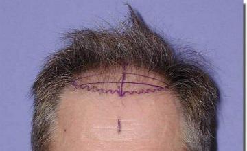 Hair restoration procedure results