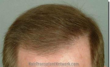 Hair restoration procedure results