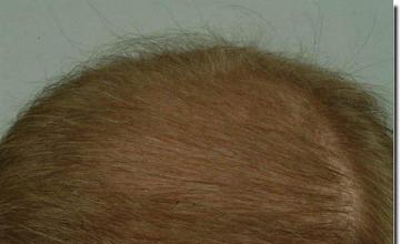 Hair restoration procedure results