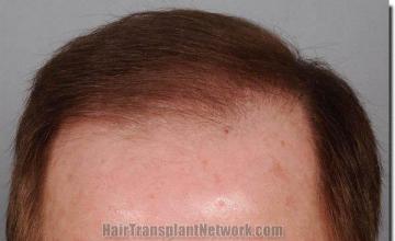 Hair restoration procedure results