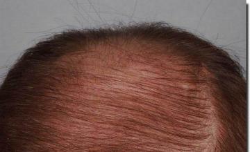 Hair restoration procedure results