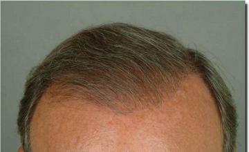 Hair restoration procedure results