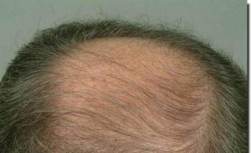 Hair restoration procedure results