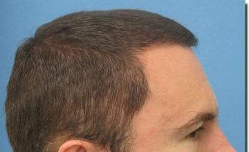 Hair restoration procedure results